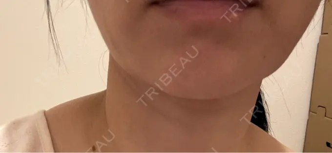 シワ取りボトックス AB美容クリニック 新宿院 DAY 1 メイン用