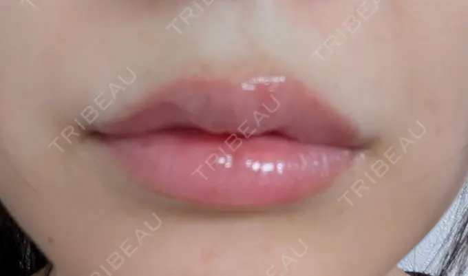 ヒアルロン酸注入（唇） 新未来クリニック DAY 6 メイン用