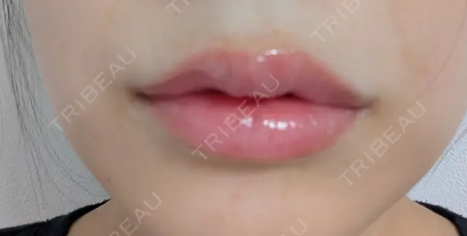 ヒアルロン酸注入（唇） 新未来クリニック DAY 7 メイン用