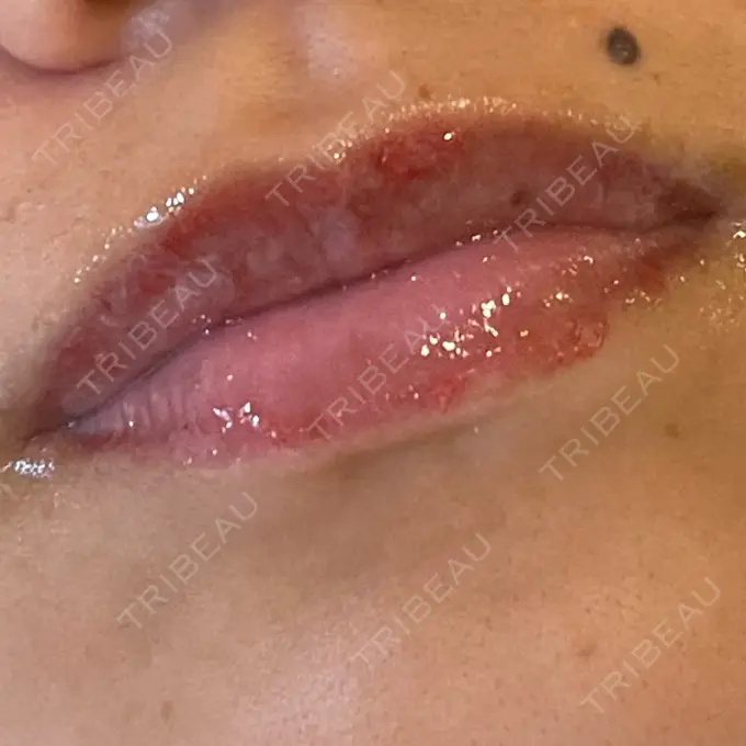 アートメイク（唇） LEAGRANT CLINIC 中目黒 DAY 4 メイン用