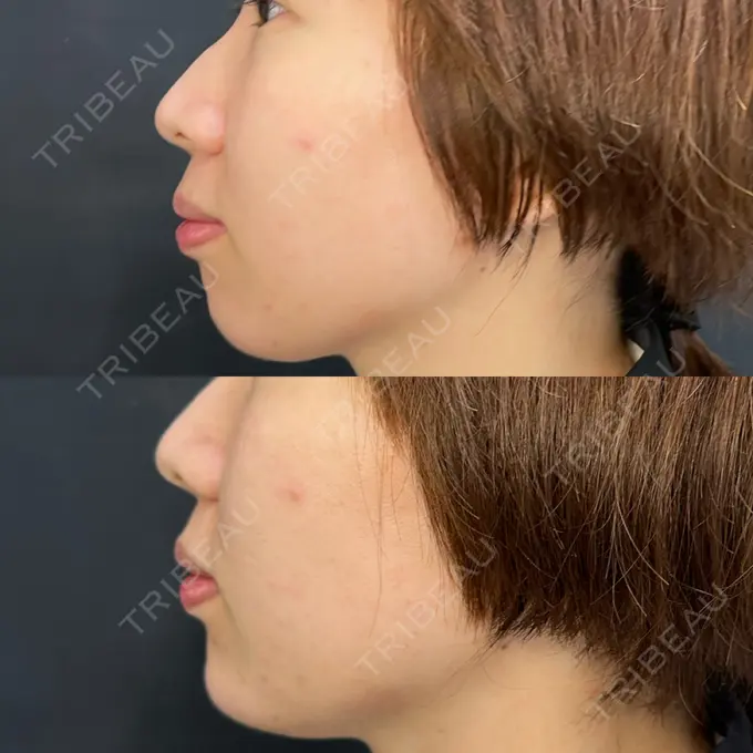 ボトックス（あご） / ヒアルロン酸注入（あご） ルラ美容クリニック 渋谷本院 AFTER メイン用