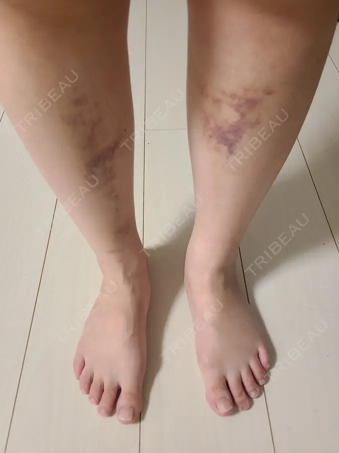 脂肪吸引（顔） / 脂肪吸引（脚） / 脂肪吸引（お尻） GAYA body design clinic DAY 15 メイン用