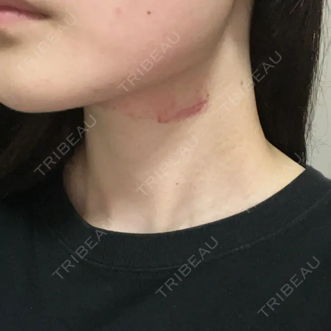 その他（輪郭） ルラ美容クリニック 大阪心斎橋院 AFTER メイン用