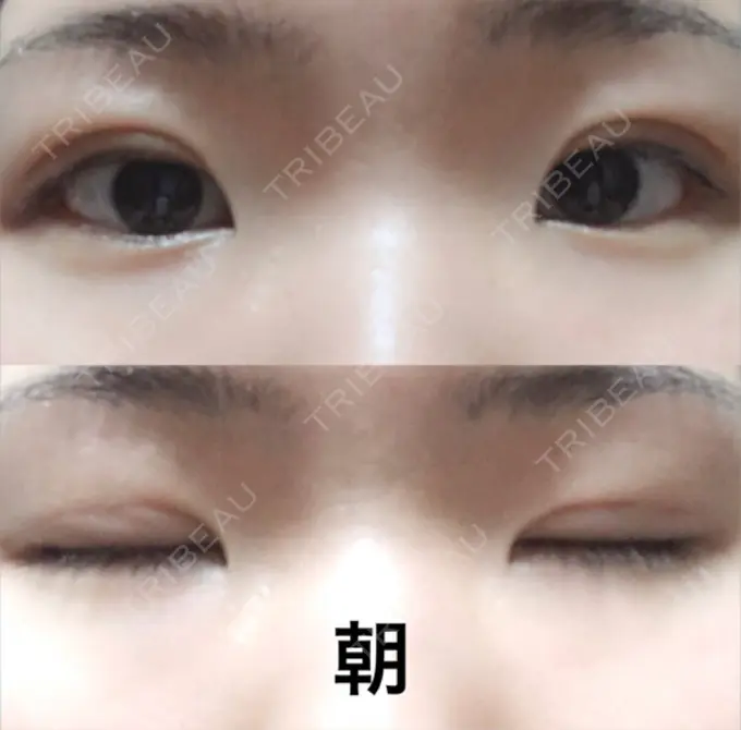 二重埋没 / 上まぶたの脂肪取り 東京ヒルズクリニック 岡崎院 DAY 28 メイン用