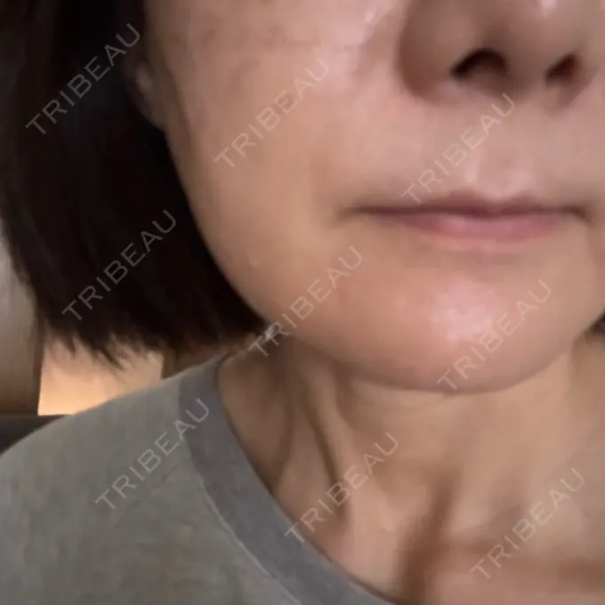 肌育注射（ジュベルックなど） SUNMELIA SKIN CLINIC DAY 2 メイン用