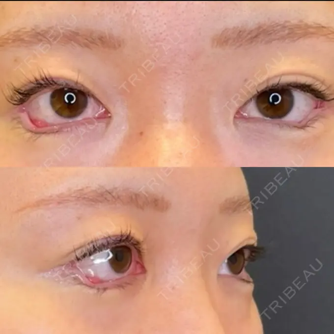 目尻切開 / タレ目形成・グラマラスライン（埋没） / その他（肌） LOUIS CLINIC 二子玉川院【ルイクリニック】 DAY 0 メイン用