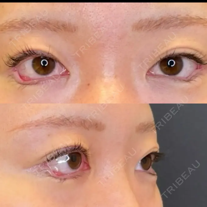 目尻切開 / タレ目形成・グラマラスライン（埋没） / その他（肌） LOUIS CLINIC 二子玉川院【ルイクリニック】 DAY 0 メイン用