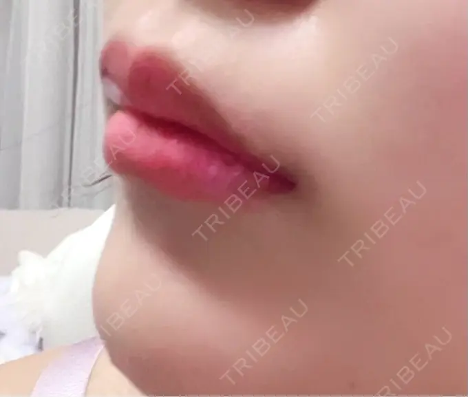 ボトックス（あご） / ヒアルロン酸注入（唇） / ボトックス（口角） / その他（輪郭） ルラ美容クリニック 大阪心斎橋院 DAY 2 メイン用