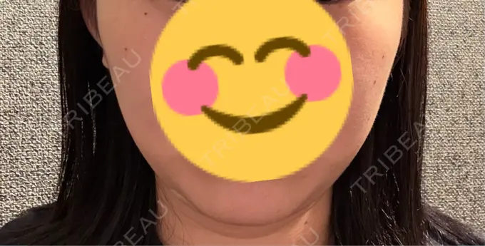 脂肪吸引（顔） / 脂肪吸引注射（顔） ziz CLINIC DAY 8 メイン用