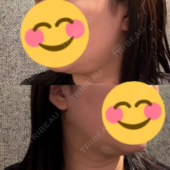 脂肪吸引（顔） / 脂肪吸引注射（顔） ziz CLINIC DAY 8 メイン用