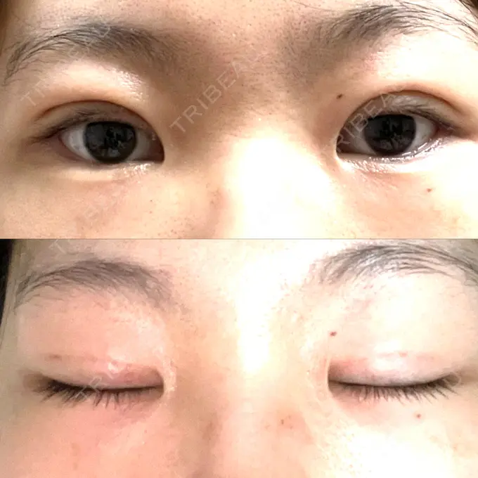 二重埋没 オアシス美容外科 DAY 9 メイン用