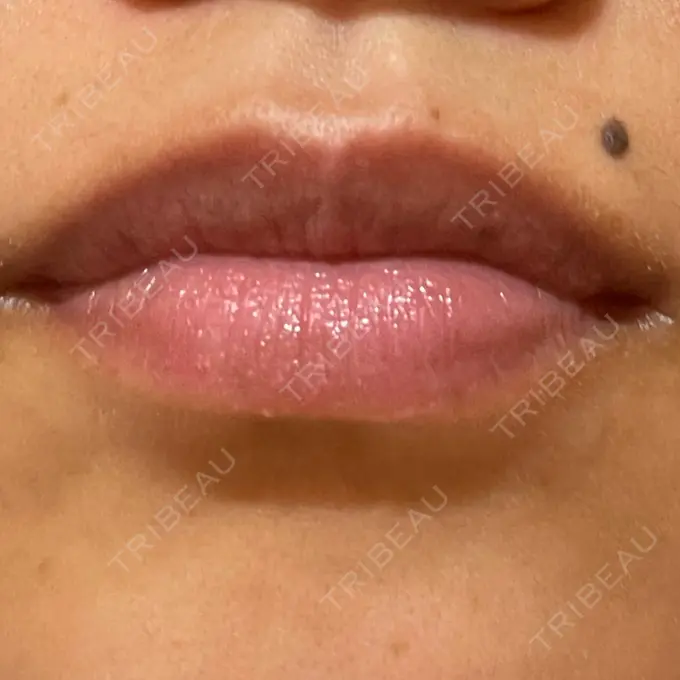 アートメイク（唇） LEAGRANT CLINIC 中目黒 DAY 5 メイン用