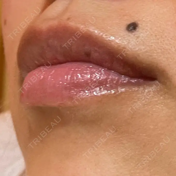 アートメイク（唇） LEAGRANT CLINIC 中目黒 DAY 5 メイン用