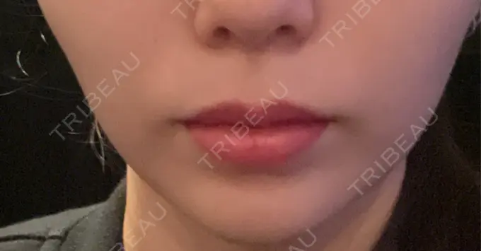 ボトックス（口角） ルラ美容クリニック 広島院 DAY 32 メイン用