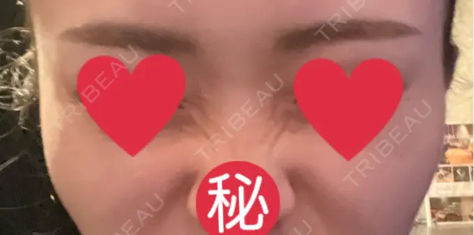 ボトックス（バニーライン） 共立美容外科 広島院 DAY 29 メイン用