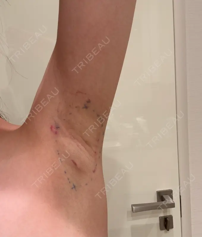 ワキ汗治療（レーザー） ルラ美容クリニック 渋谷本院 DAY 1 メイン用