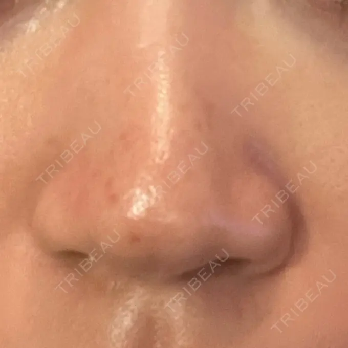 アグネス KM新宿クリニック DAY 13 メイン用