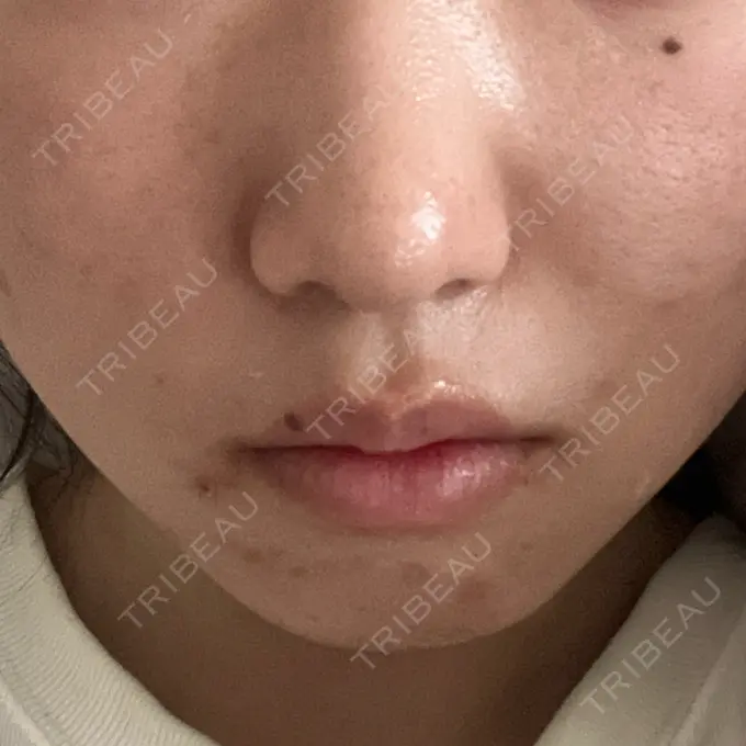 ヒアルロン酸注入（鼻翼基部） ジョウクリニック 大阪院 AFTER メイン用