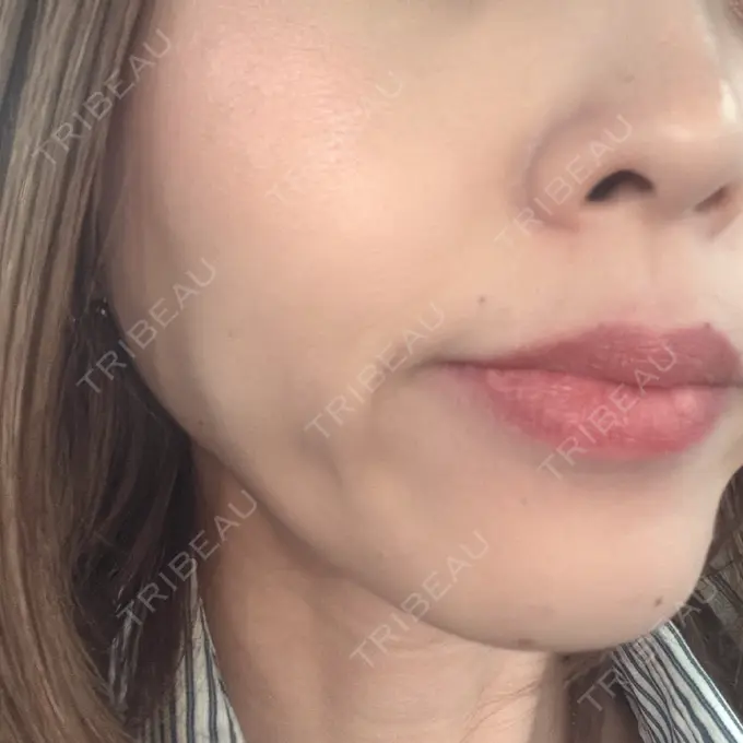 ボトックス（あご） / ボトックス（口角） / ボトックス（眉間） / ボトックス（額） TCB東京中央美容外科 札幌駅前院 DAY 7 メイン用