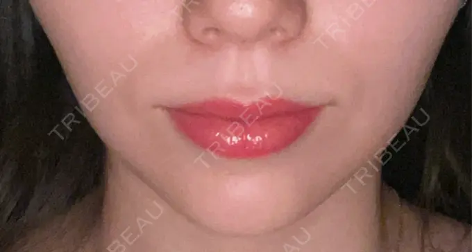 ボトックス（口角） ルラ美容クリニック 広島院 AFTER メイン用