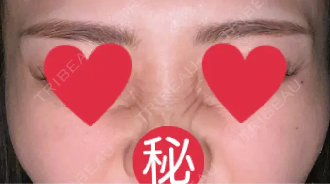 ボトックス（バニーライン） 共立美容外科 広島院 DAY 29 メイン用