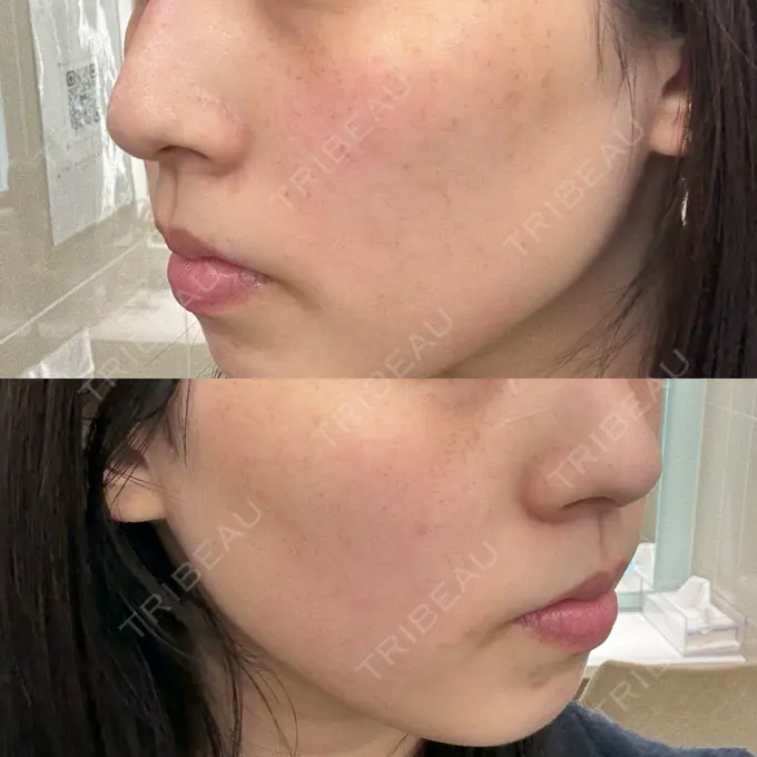 エレクトロポレーション SK新宿歌舞伎町美容外科・歯科 AFTER メイン用