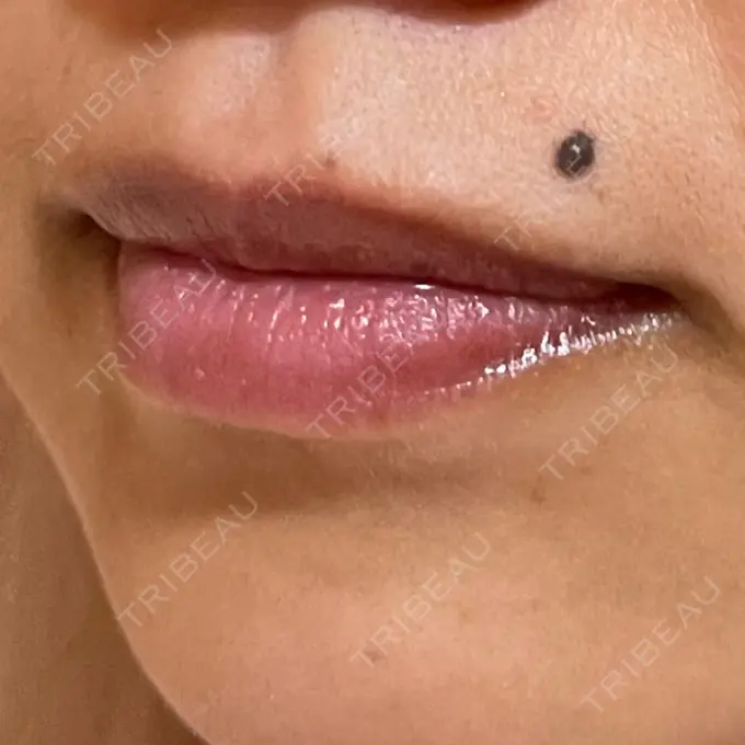 アートメイク（唇） LEAGRANT CLINIC 中目黒 DAY 6 メイン用
