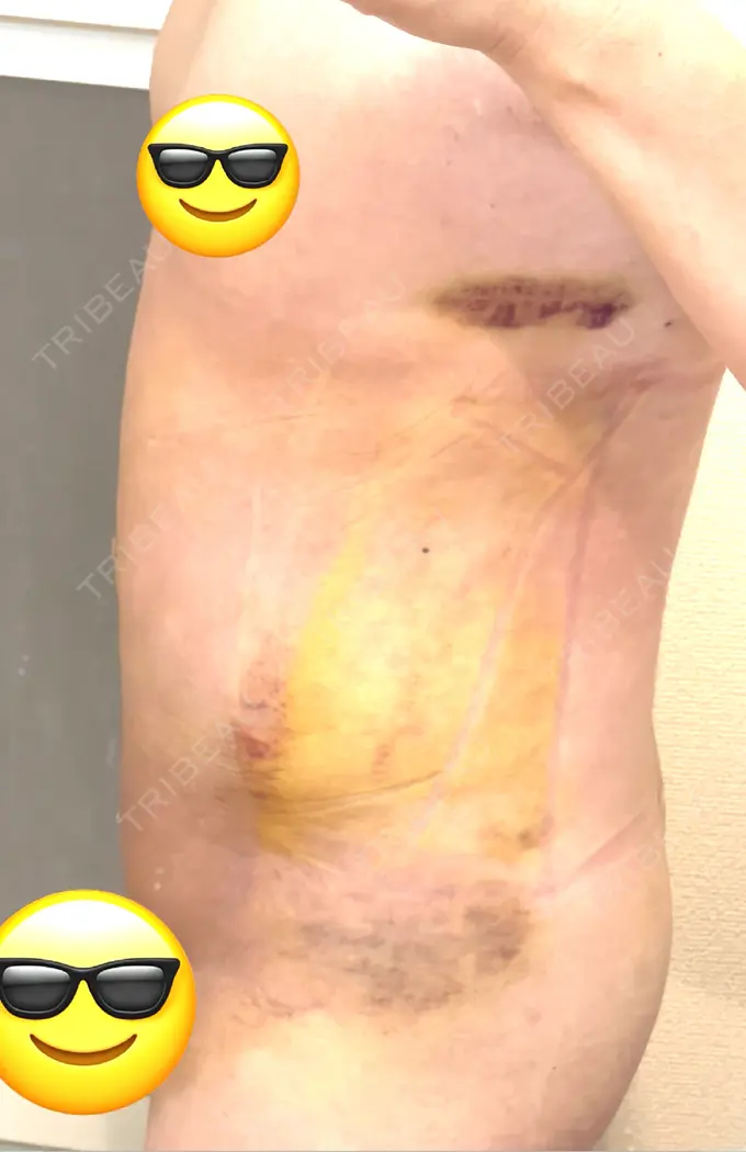 脂肪吸引（お腹） / 脂肪吸引（腰） オアシス美容外科 DAY 6 メイン用