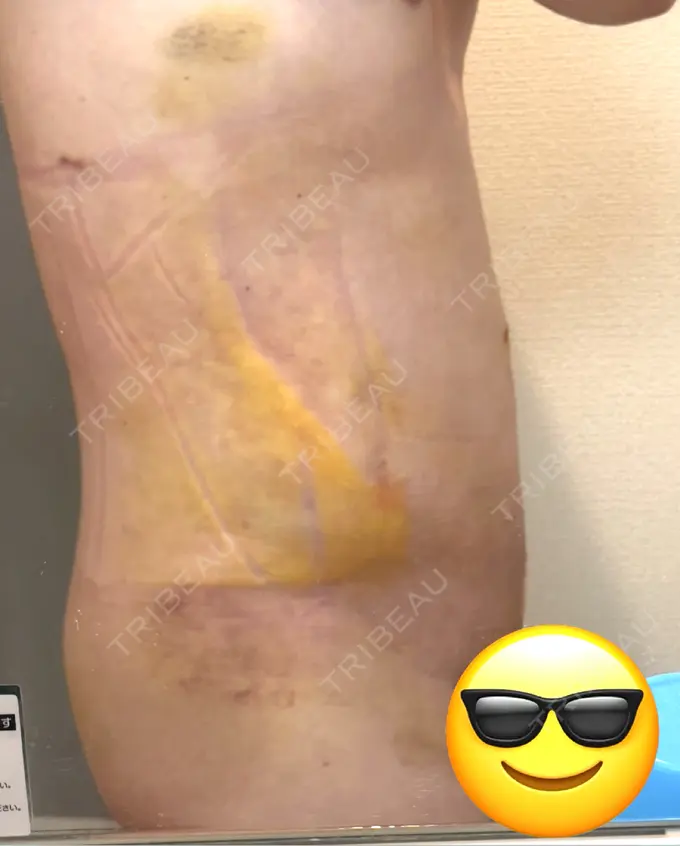 脂肪吸引（お腹） / 脂肪吸引（腰） オアシス美容外科 DAY 6 メイン用