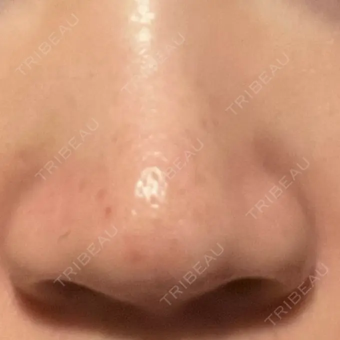 アグネス KM新宿クリニック DAY 14 メイン用