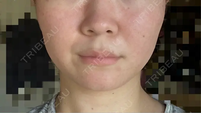 ボトックス（エラ・小顔） アリエル美容クリニック 横浜院 DAY 21 メイン用