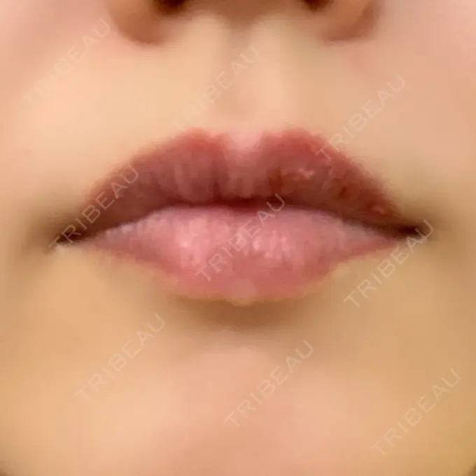 アートメイク（唇） ルーチェクリニック 銀座院 DAY 2 メイン用