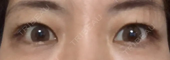 ヒアルロン酸注入（涙袋） 小倉美容外科/美容皮膚科 ビラビューティークリニック AFTER メイン用