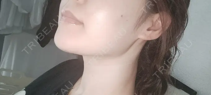 ボトックス（エラ・小顔） / ボトックス（口角） / ボトックス（額） ルラ美容クリニック 札幌本院 AFTER メイン用