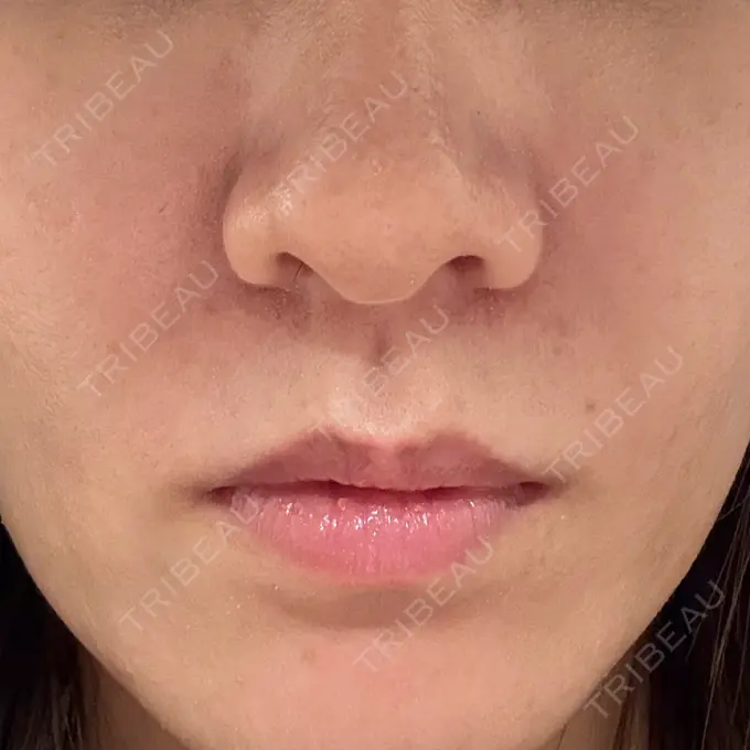 ボトックス（口角） / ボトックス（眉間） / ボトックス（目尻） ヴァージンクリニック 福岡天神院 DAY 0 メイン用