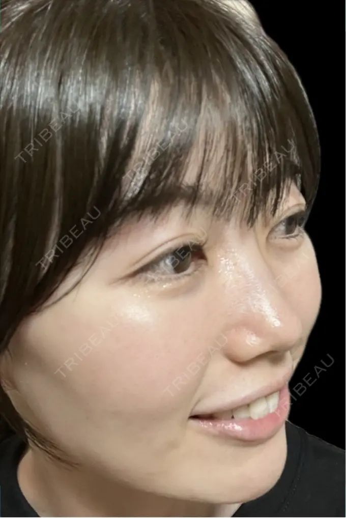 イオン導入 / 光治療（フォトフェイシャルなど） / ピーリング（ハリ・ツヤ） メディアージュクリニック 青山院 AFTER メイン用