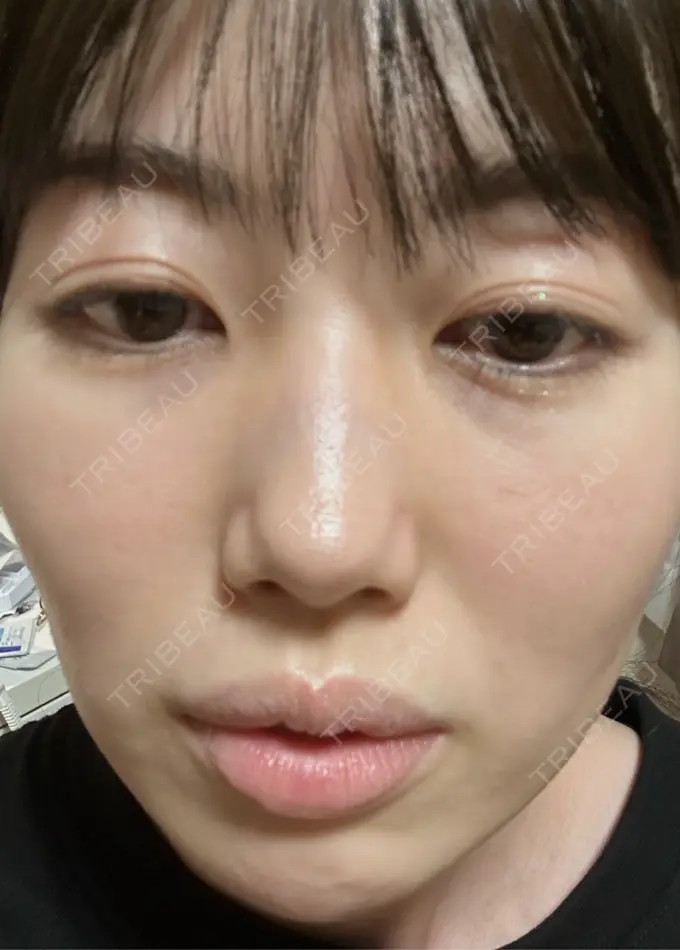 イオン導入 / 光治療（フォトフェイシャルなど） / ピーリング（ハリ・ツヤ） メディアージュクリニック 青山院 DAY 4 メイン用