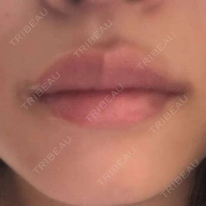 ヒアルロン酸注入（唇） / ボトックス（口角） / その他（口元） 銀座美容外科クリニック 銀座院 AFTER メイン用