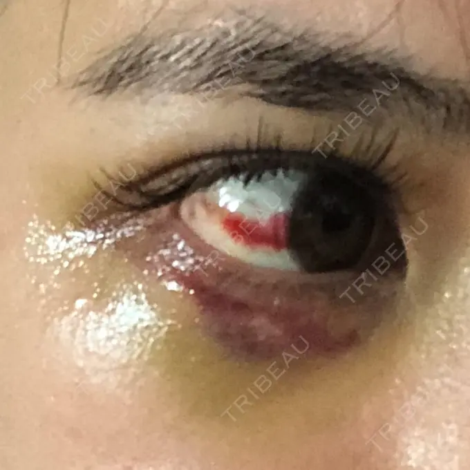 ヒアルロン酸注入（涙袋） / ヒアルロン酸注入（鼻） / ボトックス（エラ・小顔） / ヒアルロン酸注入（唇） TCB東京中央美容外科 新宿東口院 AFTER メイン用