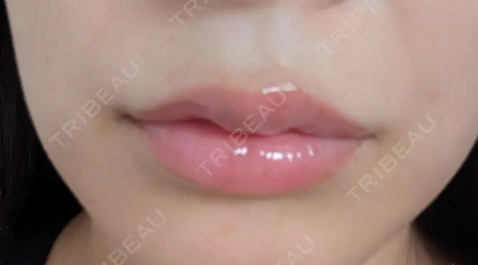 ヒアルロン酸注入（唇） 新未来クリニック DAY 8 メイン用