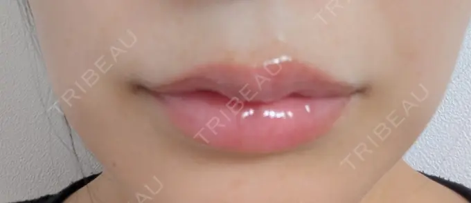 ヒアルロン酸注入（唇） 新未来クリニック DAY 9 メイン用