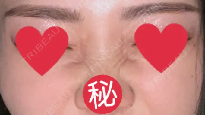 ボトックス（バニーライン） 共立美容外科 広島院 DAY 30 メイン用