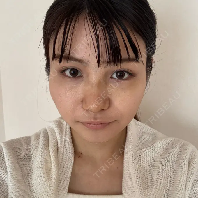 隆鼻術 / 鼻尖形成（切開） / 軟骨移植 / ワシ鼻修正・ハンプ切除 ダビダ整形外科 AFTER メイン用