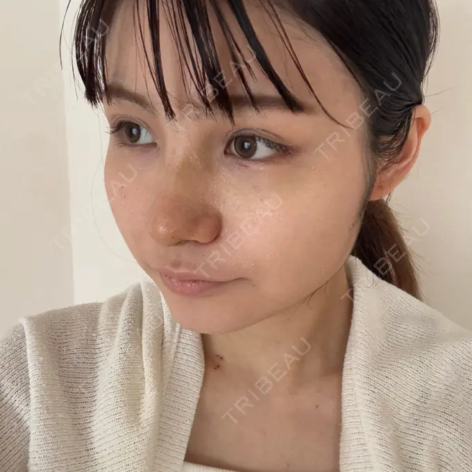 隆鼻術 / 鼻尖形成（切開） / 軟骨移植 / ワシ鼻修正・ハンプ切除 ダビダ整形外科 DAY 7 メイン用