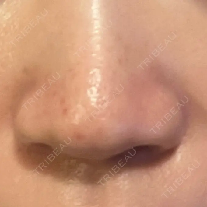 アグネス KM新宿クリニック DAY 15 メイン用