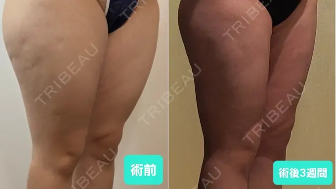 脂肪吸引（顔） / 脂肪吸引（脚） / 脂肪吸引（お尻） GAYA body design clinic DAY 22 メイン用