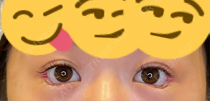 目尻切開 / タレ目形成・グラマラスライン（埋没） / ボトックス（人中） LOUIS CLINIC 二子玉川院【ルイクリニック】 DAY 0 メイン用