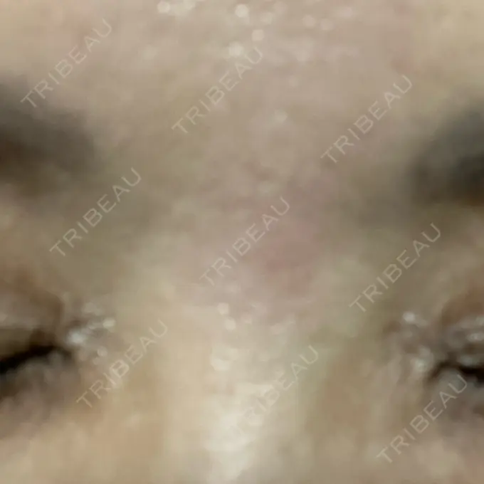 ボトックス（眉間） TCB東京中央美容外科 三島院 DAY 8 メイン用