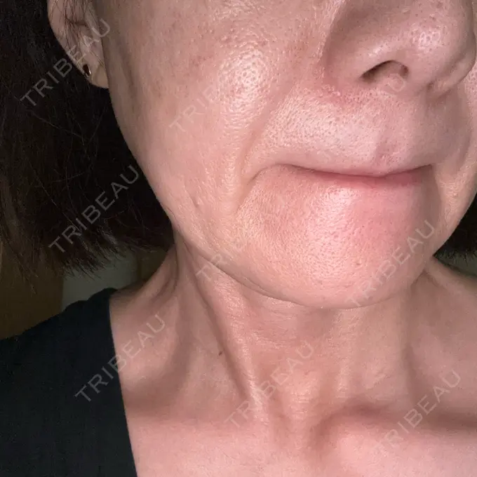 肌育注射（ジュベルックなど） SUNMELIA SKIN CLINIC DAY 5 メイン用