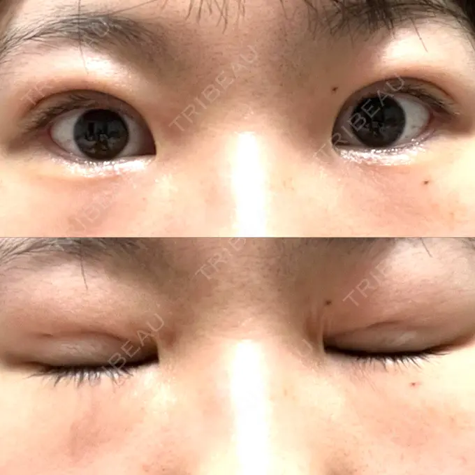 二重埋没 オアシス美容外科 DAY 11 メイン用